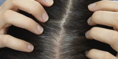 Saçta Egzama Tedavileri