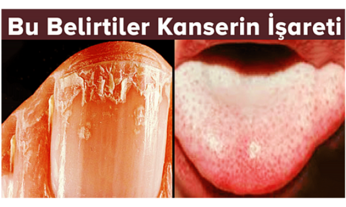 Bu Belirtiler Kanserin İşareti