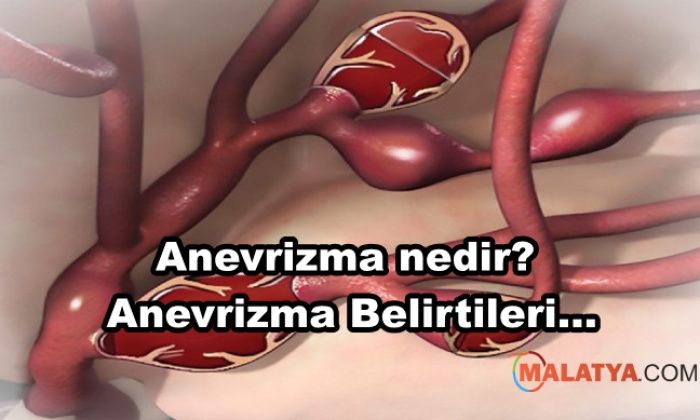 Anevrizma nedir? Anevrizma Belirtileri Nelerdir?