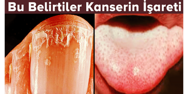 Bu Belirtiler Kanserin İşareti
