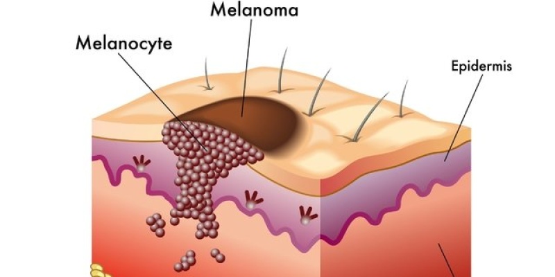 Malign Melanoma Hastası Ne Kadar Yaşar