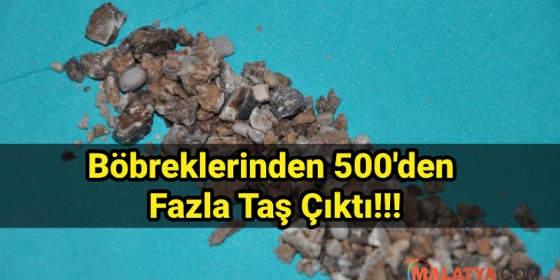 Böbreklerinden 500'den Fazla Taş Çıktı